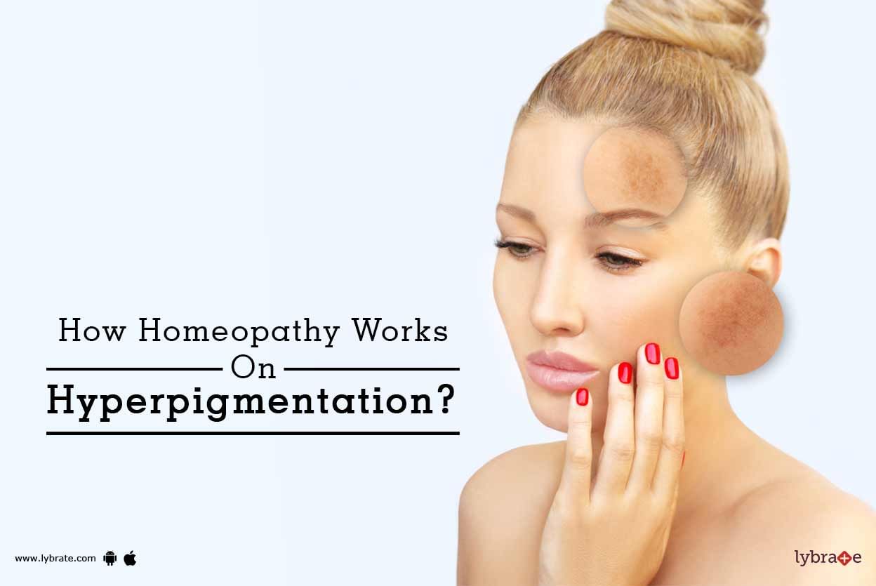 How Homeopathy Works On Hyperpigmentation?