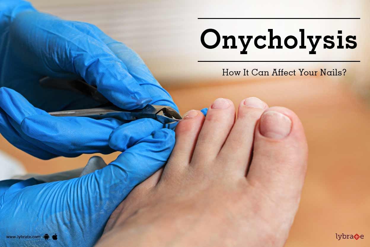 Onycholysis - How It Can Affect Your Nails?