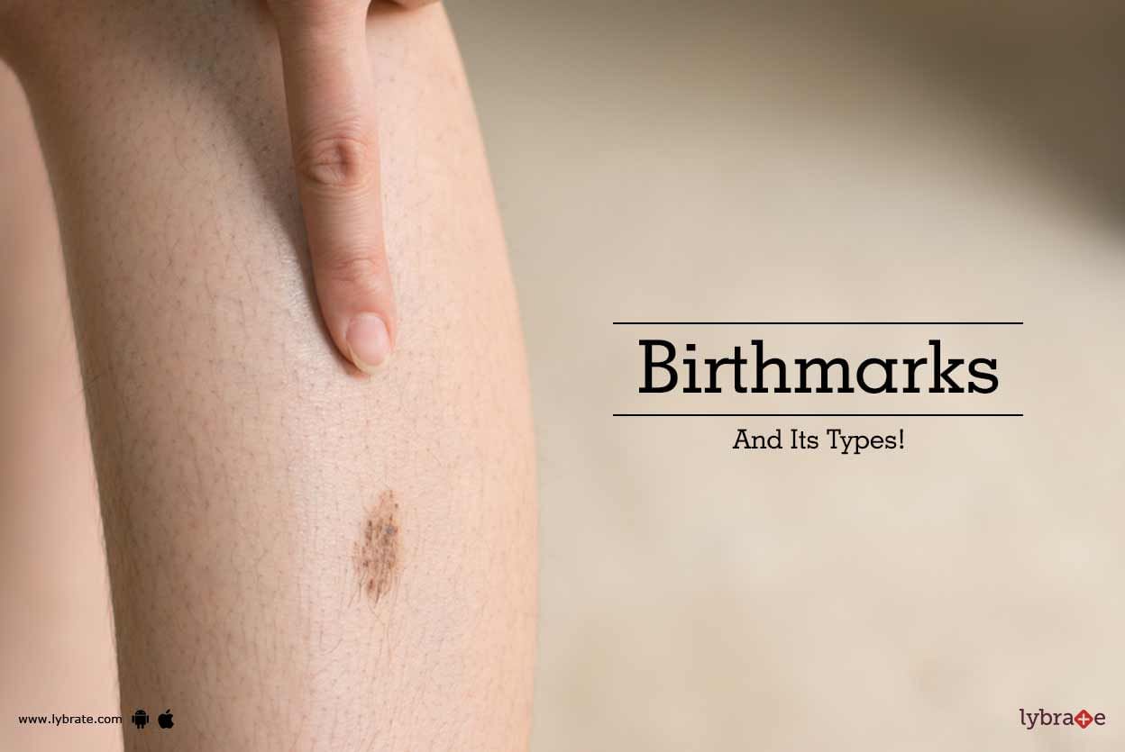 Birthmarks And Its Types!