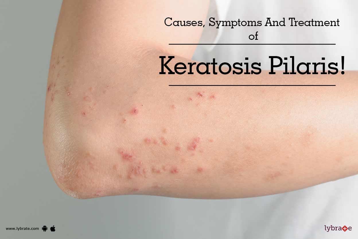 Causes, Symptoms And Treatment of Keratosis Pilaris!