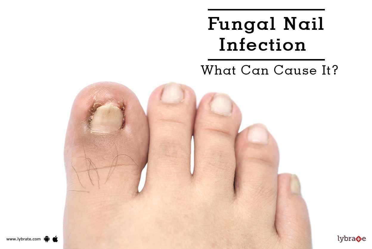 Fungal Nail Infection - What Can Cause It?