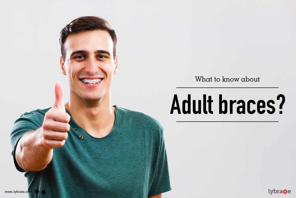 What to know about Adult braces?