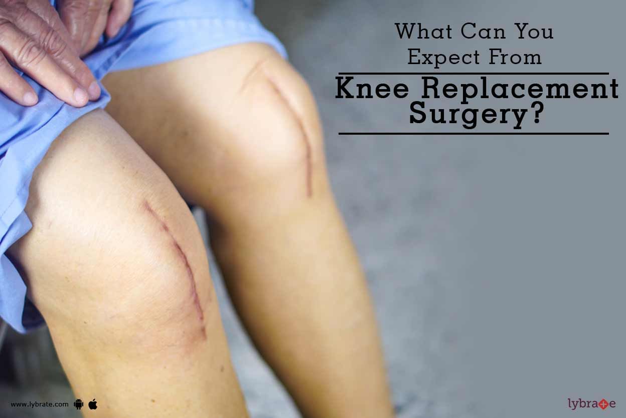 What Can You Expect From Knee Replacement Surgery?