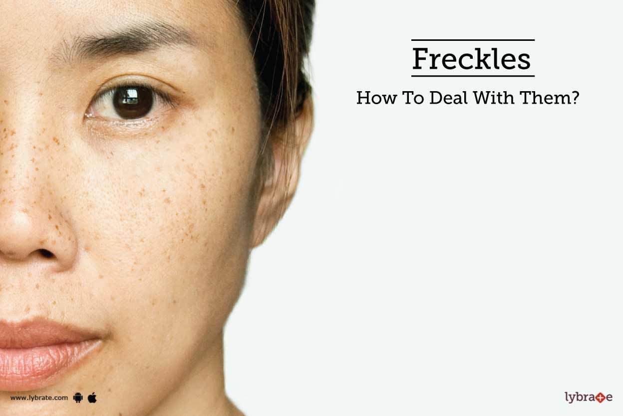 Freckles - How To Deal With Them?