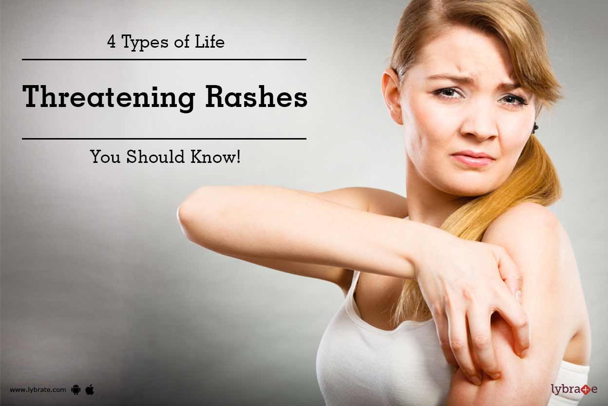 4 Types of Life Threatening Rashes You Should Know!