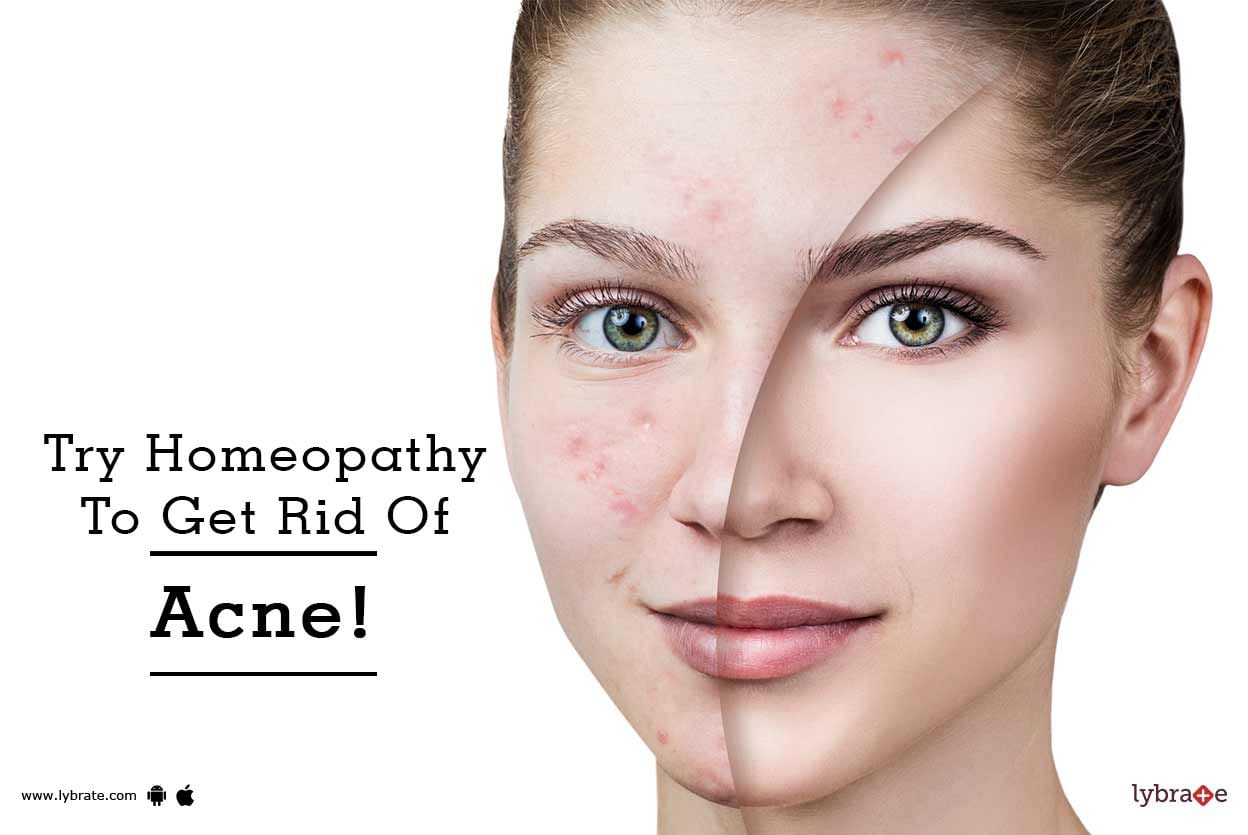 Try Homeopathy To Get Rid Of Acne!