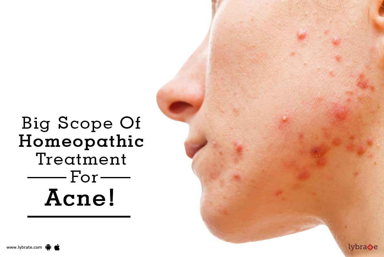 Big Scope Of Homeopathic Treatment For Acne!
