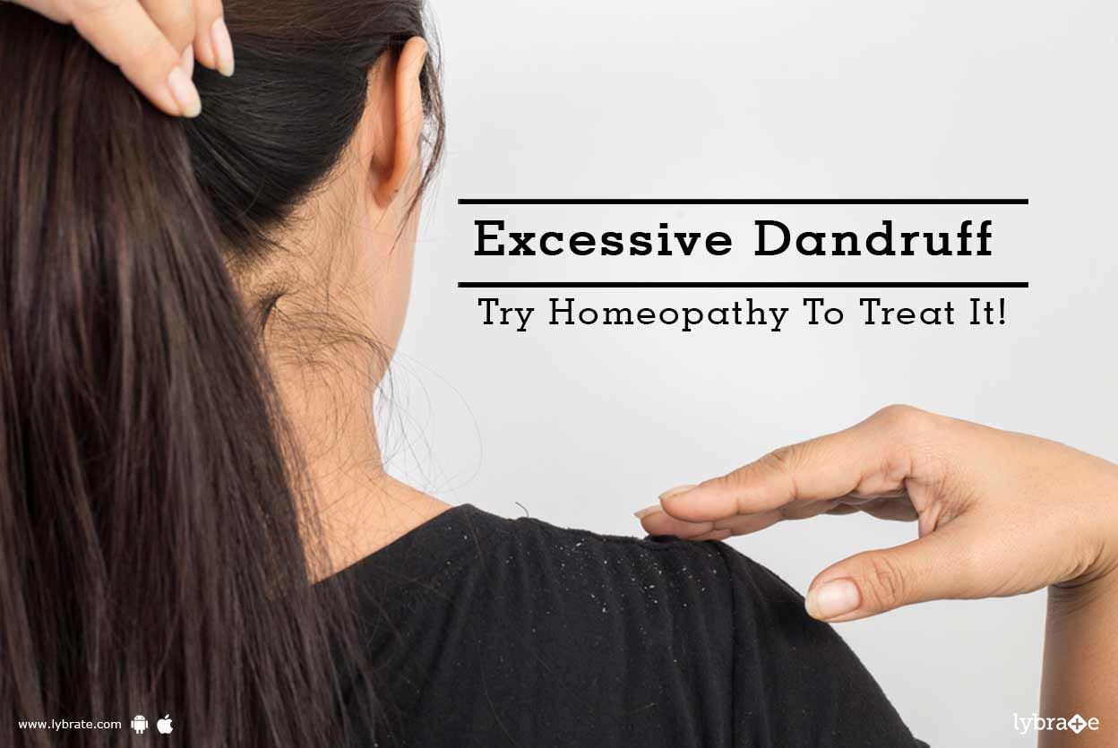Excessive Dandruff - Try Homeopathy To Treat It!