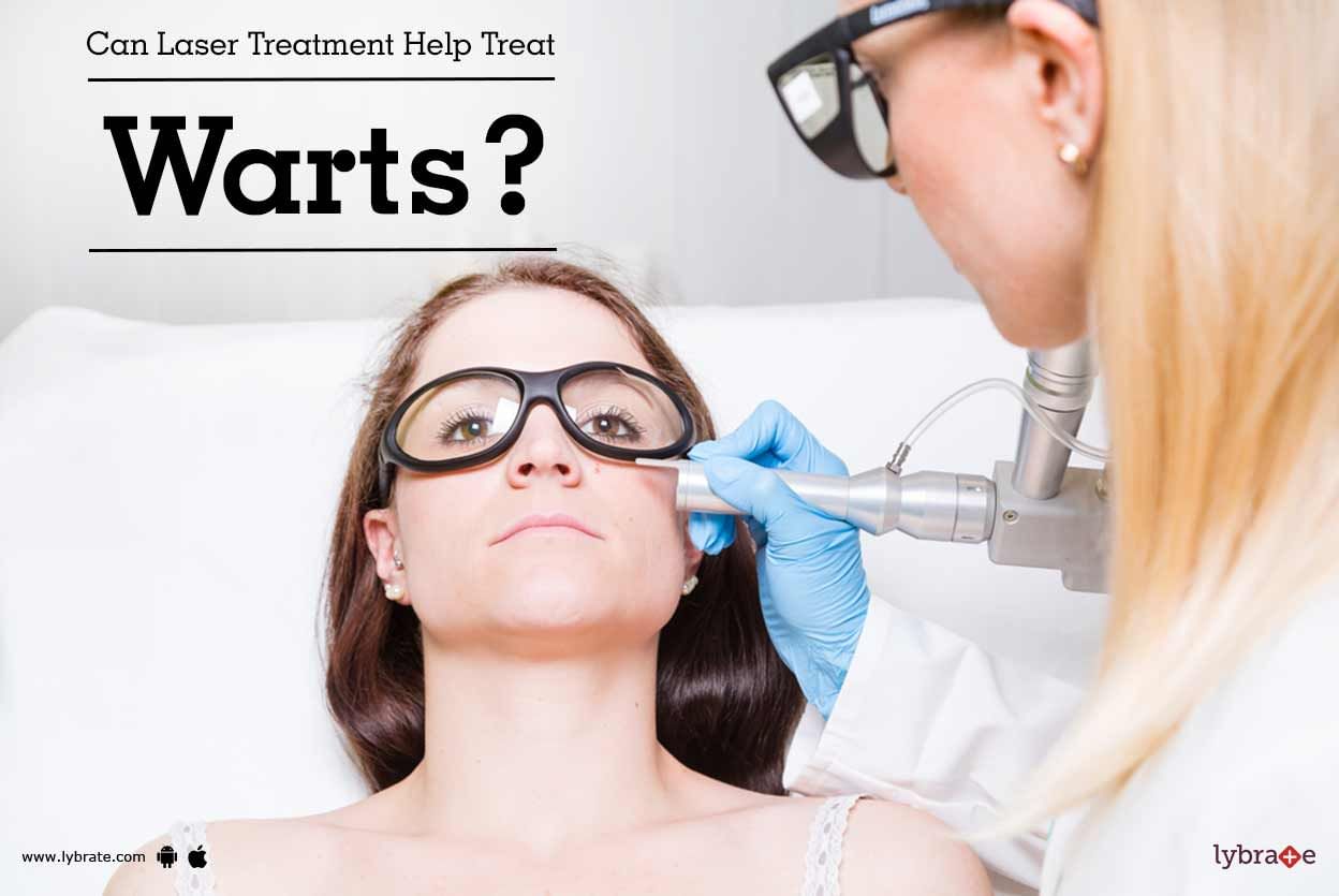 Can Laser Treatment Help Treat Warts?