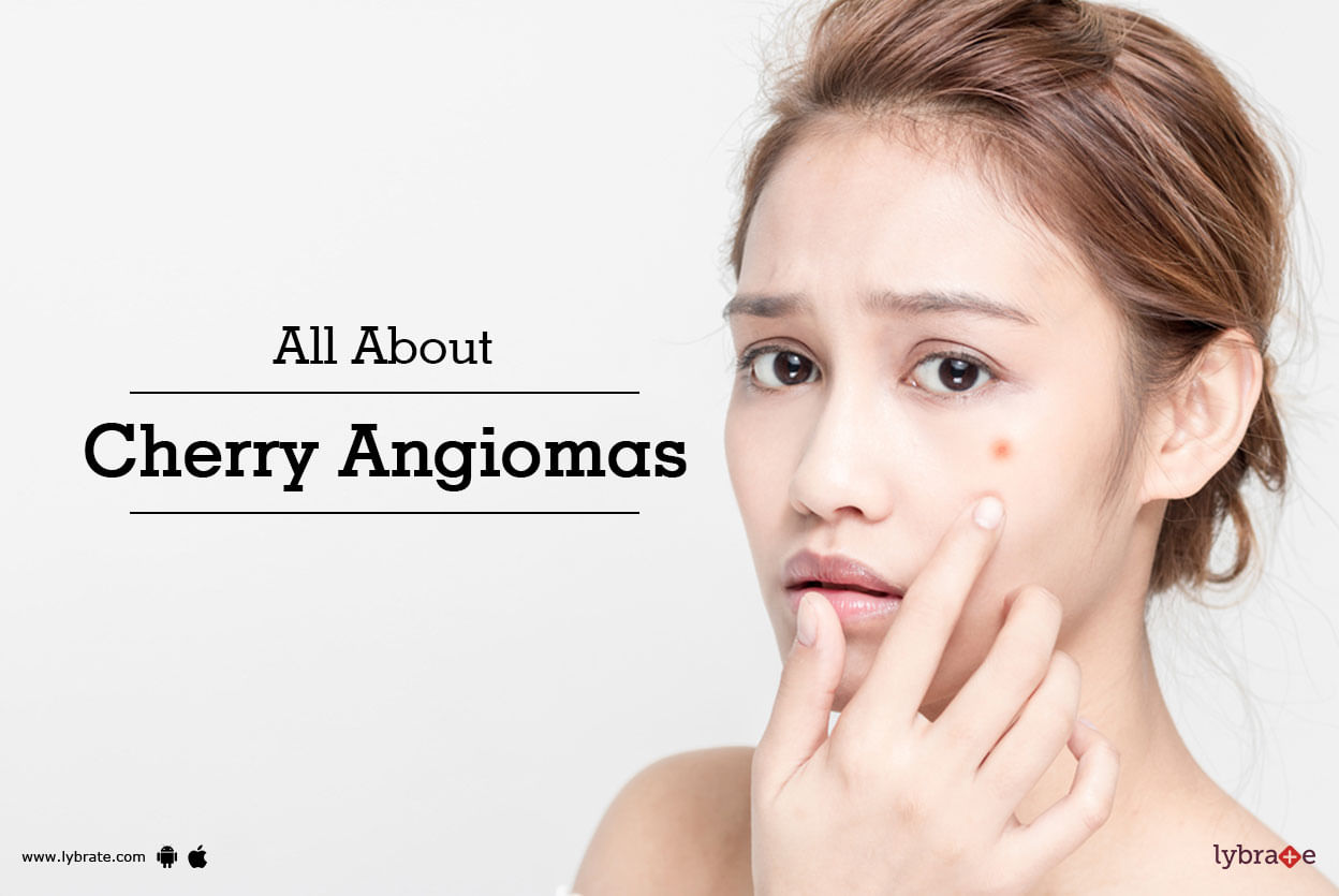 All About Cherry Angiomas