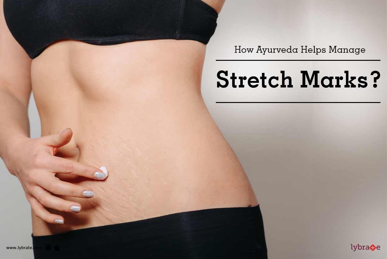 How Ayurveda Helps Manage Stretch Marks?