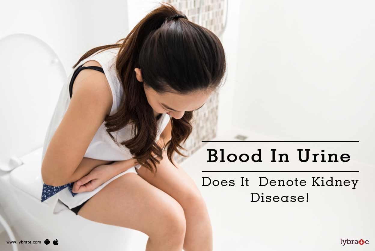 Blood In Urine -  Does It  Denote Kidney Disease!