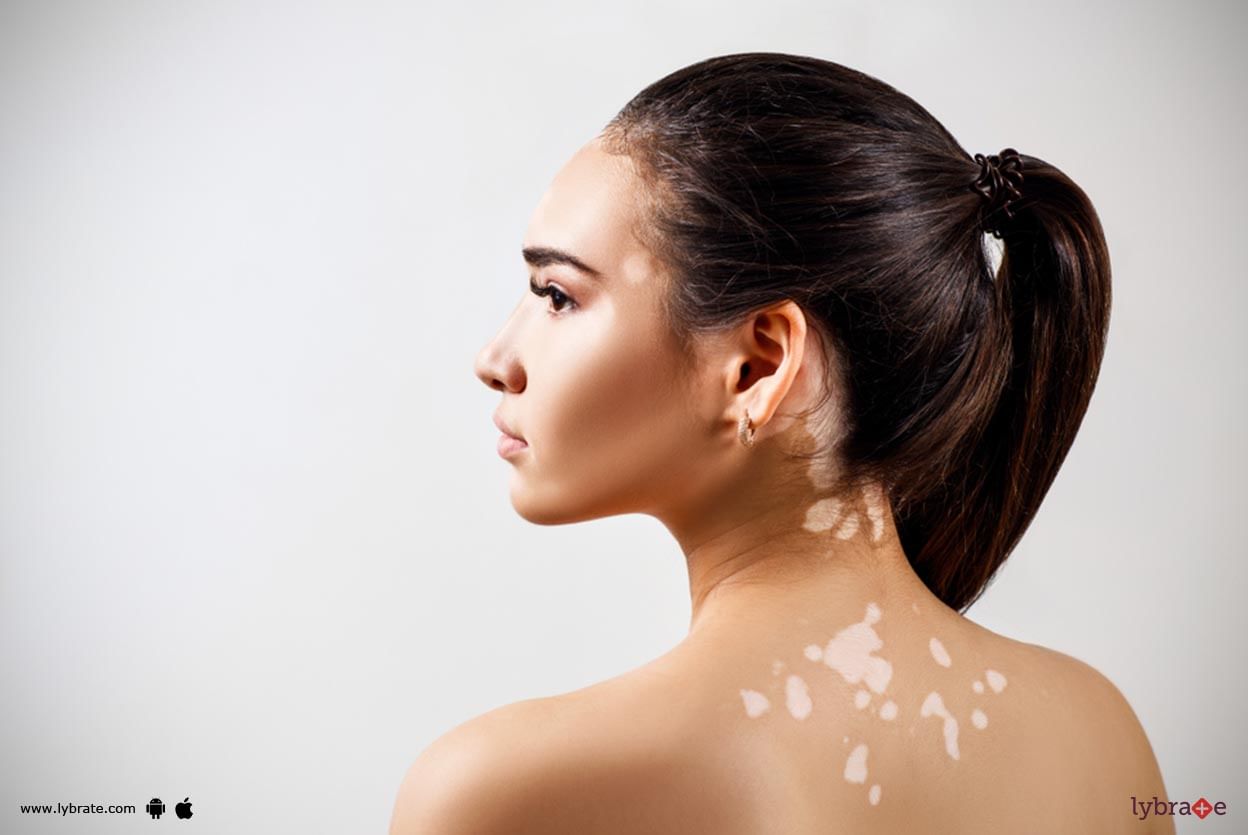 Vitiligo - Can Homeopathy Avert It?