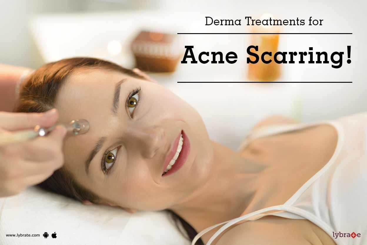 Derma Treatments for Acne Scarring!