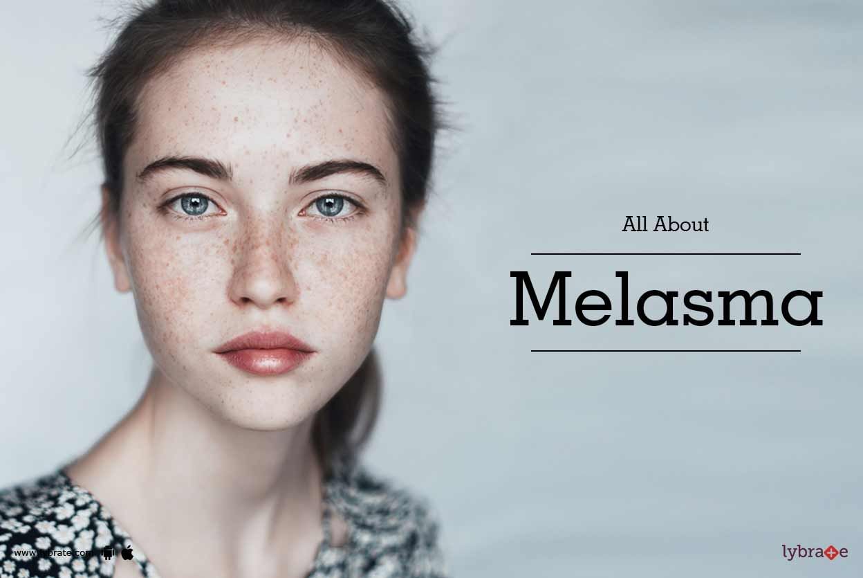 All About Melasma