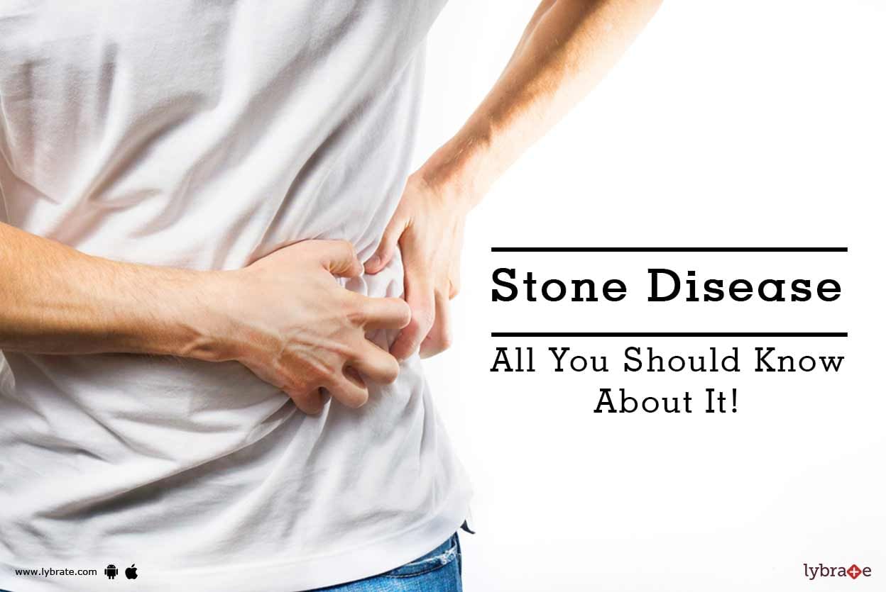 Stone Disease - All You Should Know About It!