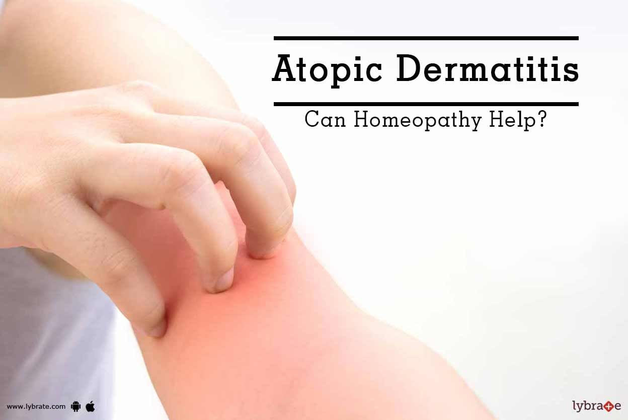 Atopic Dermatitis - Can Homeopathy Help?