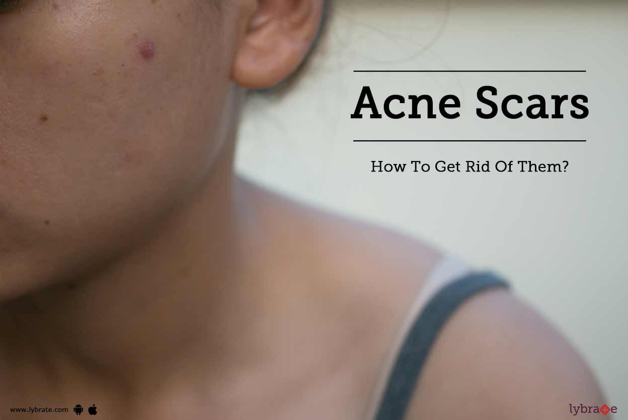 Acne Scars - How To Get Rid Of Them?