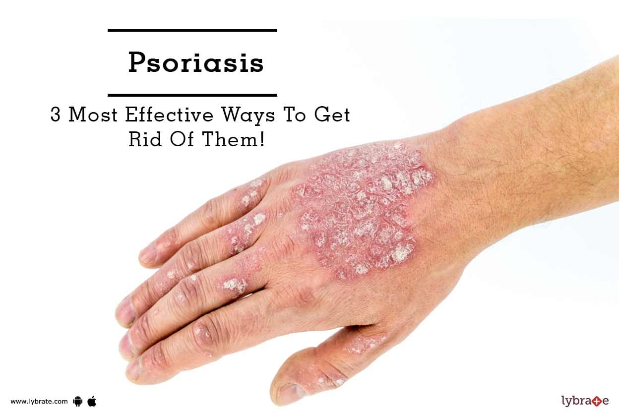 Psoriasis - 3 Most Effective Ways To Get Rid Of Them!