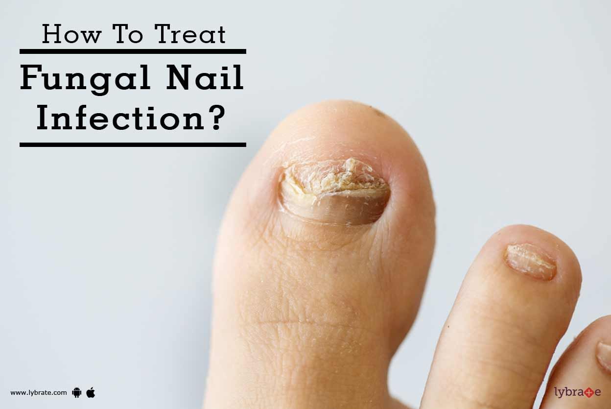 How To Treat Fungal Nail Infection?