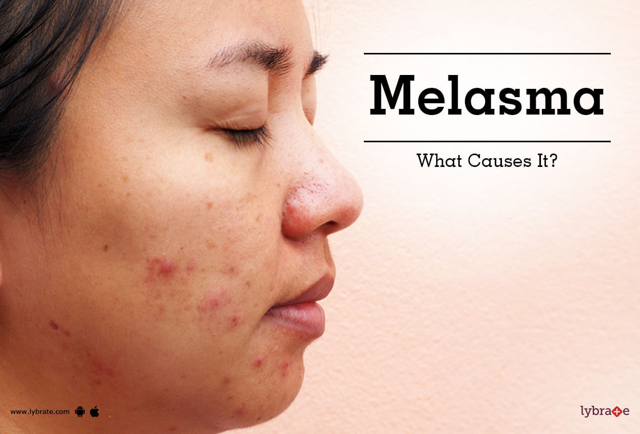 Melasma - What Causes It?