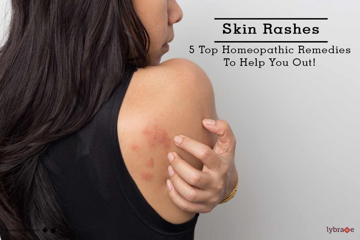 Skin Rashes - 5 Top Homeopathic Remedies To Help You Out!