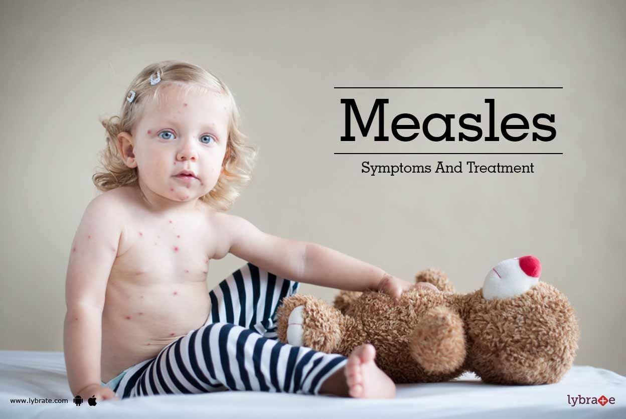 Measles - Symptoms And Treatment