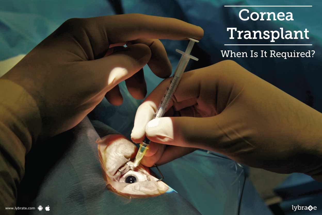 Cornea Transplant - When Is It Required?