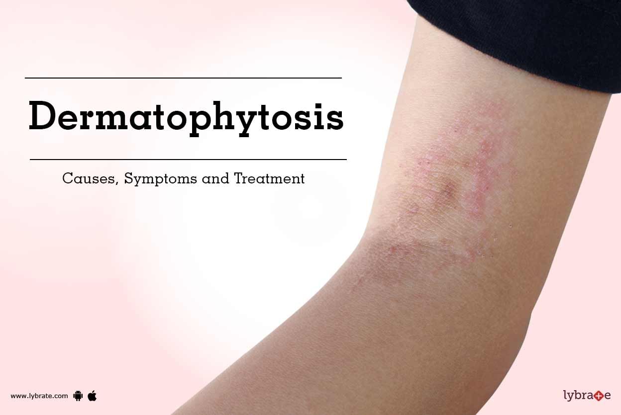 Dermatophytosis: Causes, Symptoms and Treatment