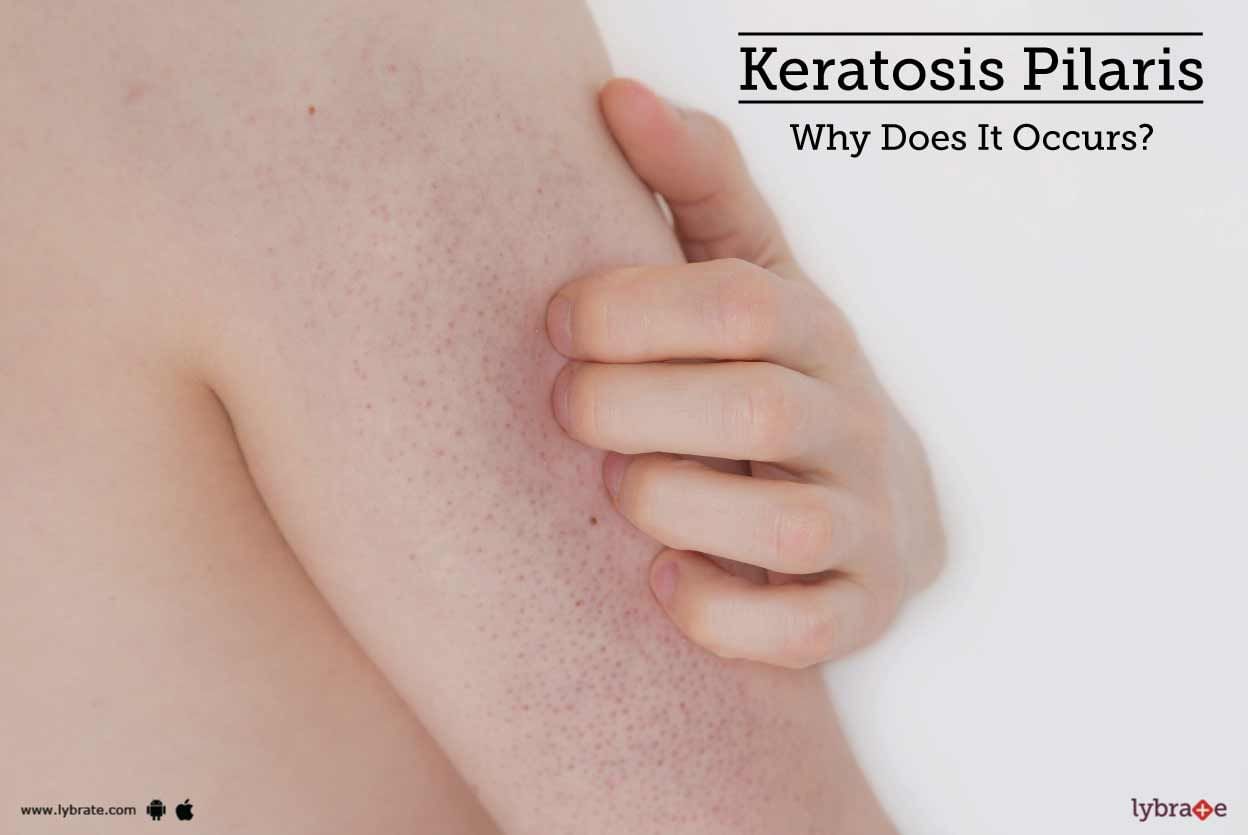 Keratosis Pilaris - Why Does It Occurs?