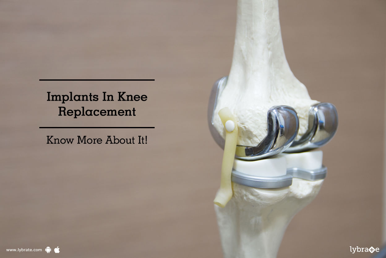 Implants In Knee Replacement - Know More About It!