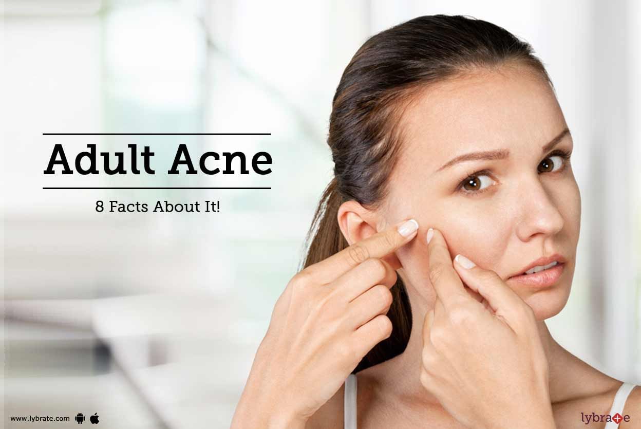 Adult Acne - 8 Facts About It!