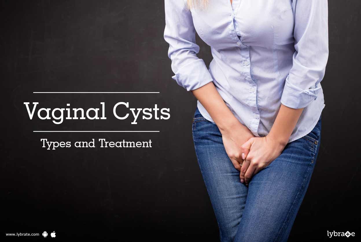 Vaginal Cysts - Types and Treatment