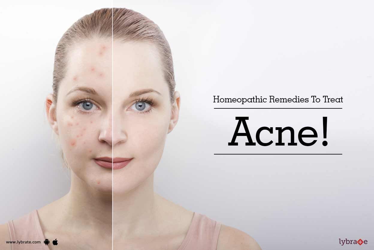 Homeopathic Remedies To Treat Acne!