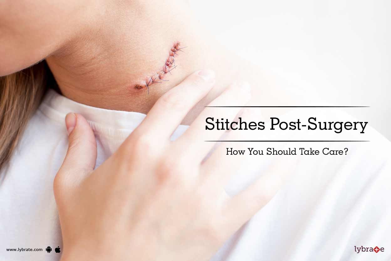Stitches Post-Surgery - How You Should Take Care?