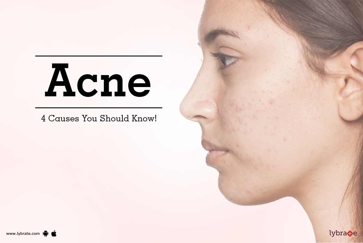 Acne - 4 Causes You Should Know!