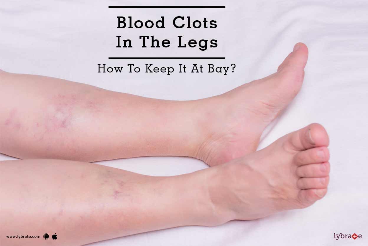 Blood Clots In The Legs - How To Keep It At Bay?