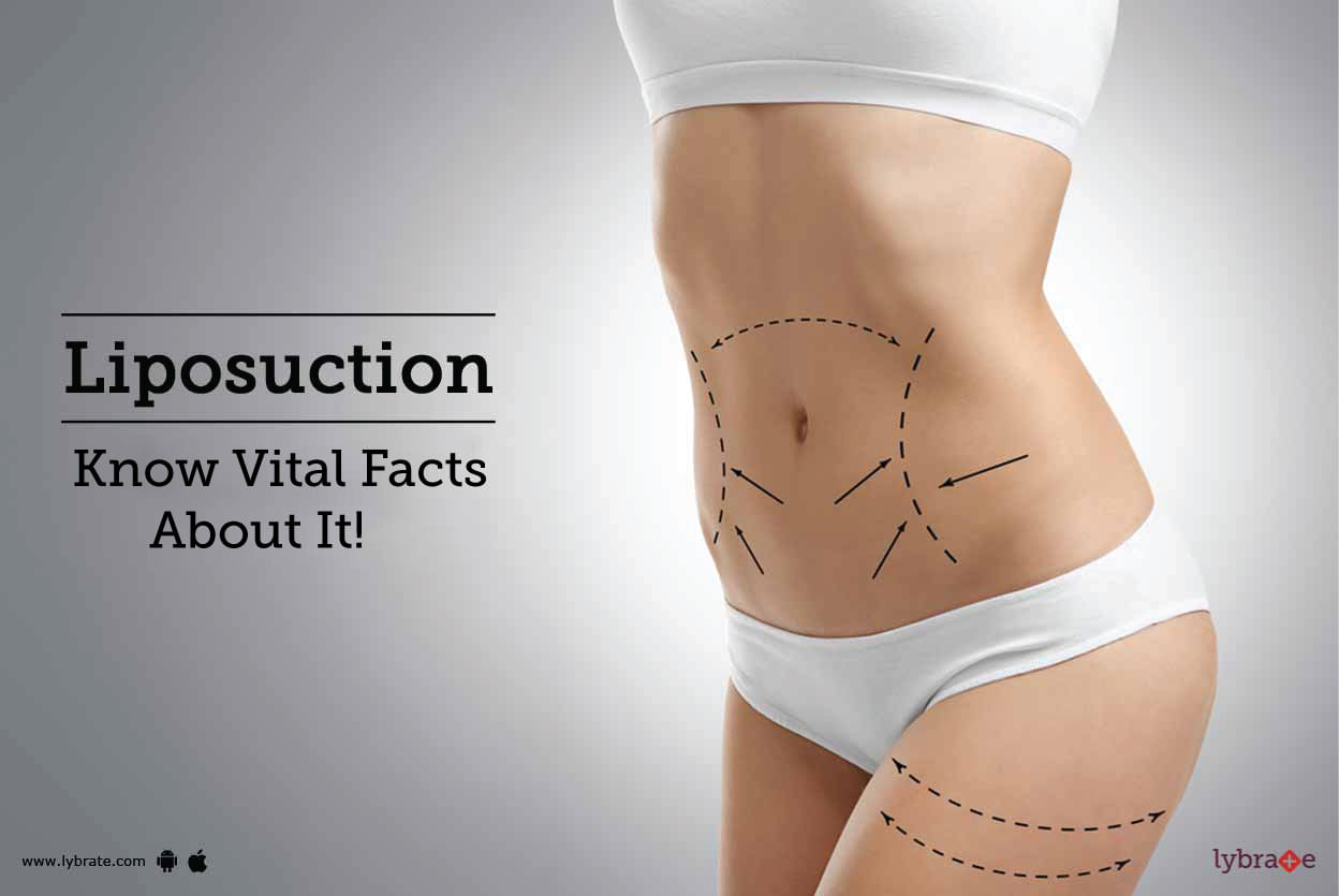 Liposuction -  Know Vital Facts About It!