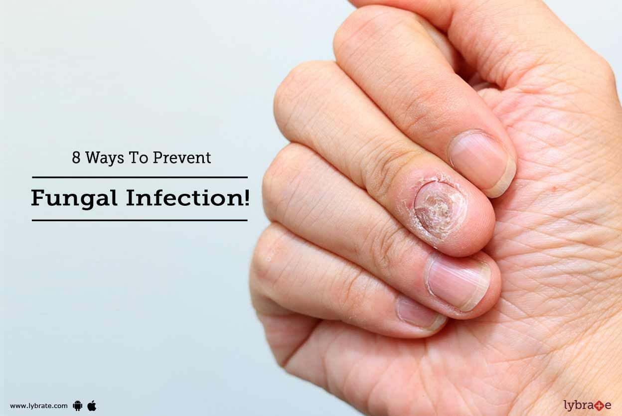 8 Ways To Prevent Fungal Infection!