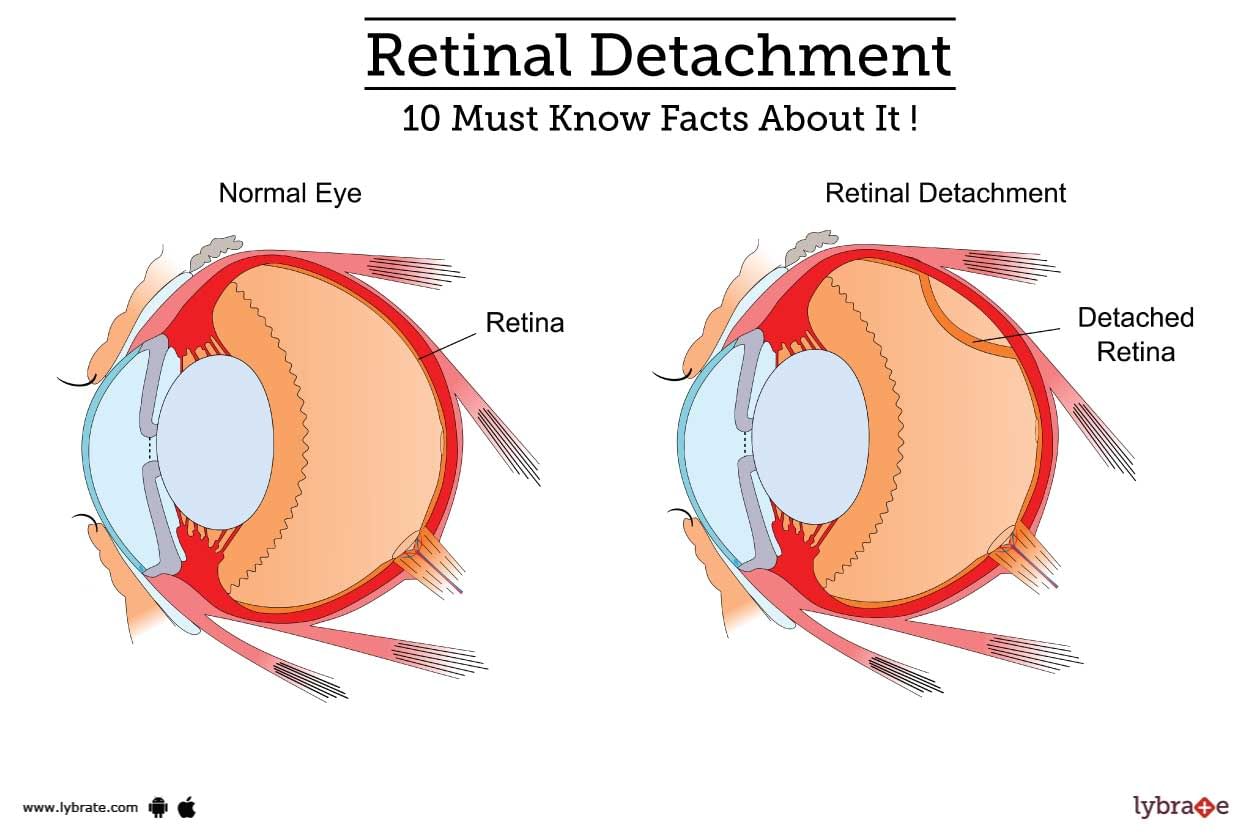 Retinal Detachment - 10 Must Know Facts About It!