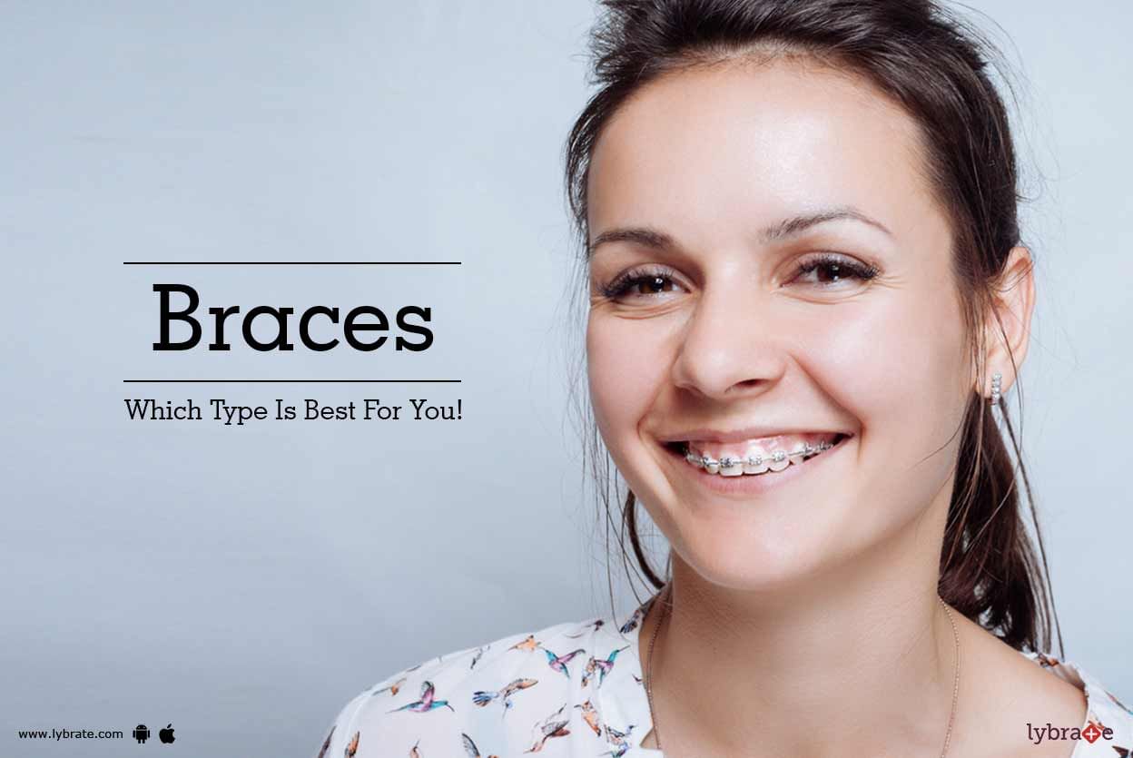 Braces - Which Type Is Best For You!