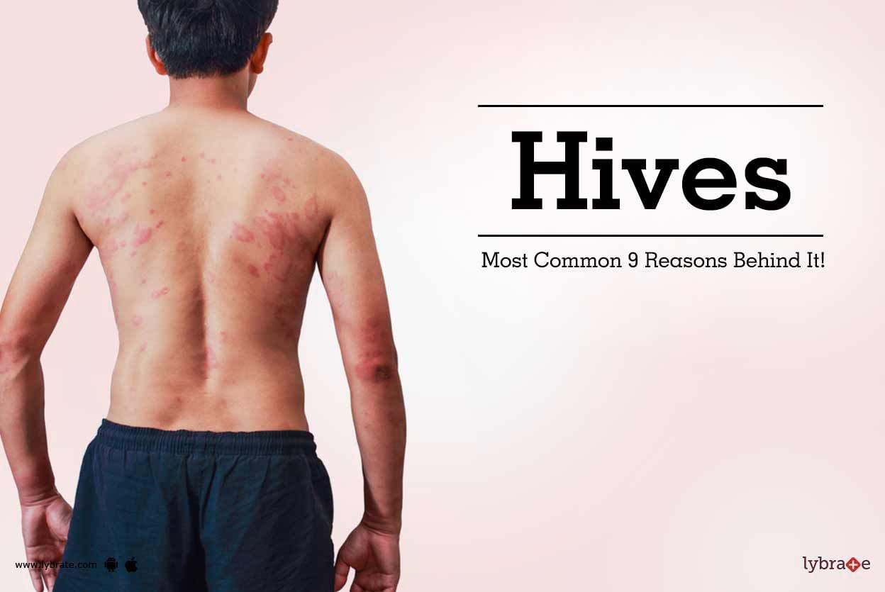 Hives - Most Common 9 Reasons Behind It!
