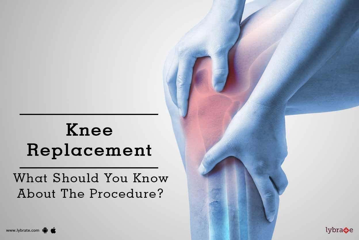 Knee Replacement - What Should You Know About The Procedure?