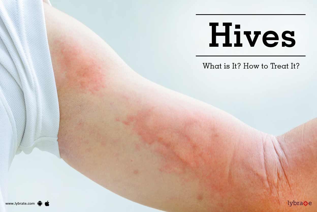 Hives: What is It? How to Treat It?