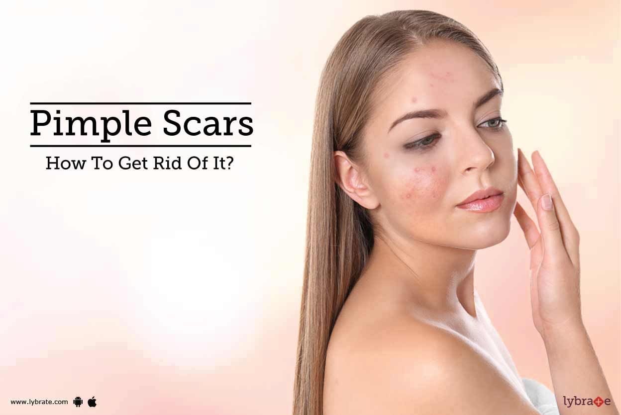 Pimple Scars - How To Get Rid Of It?