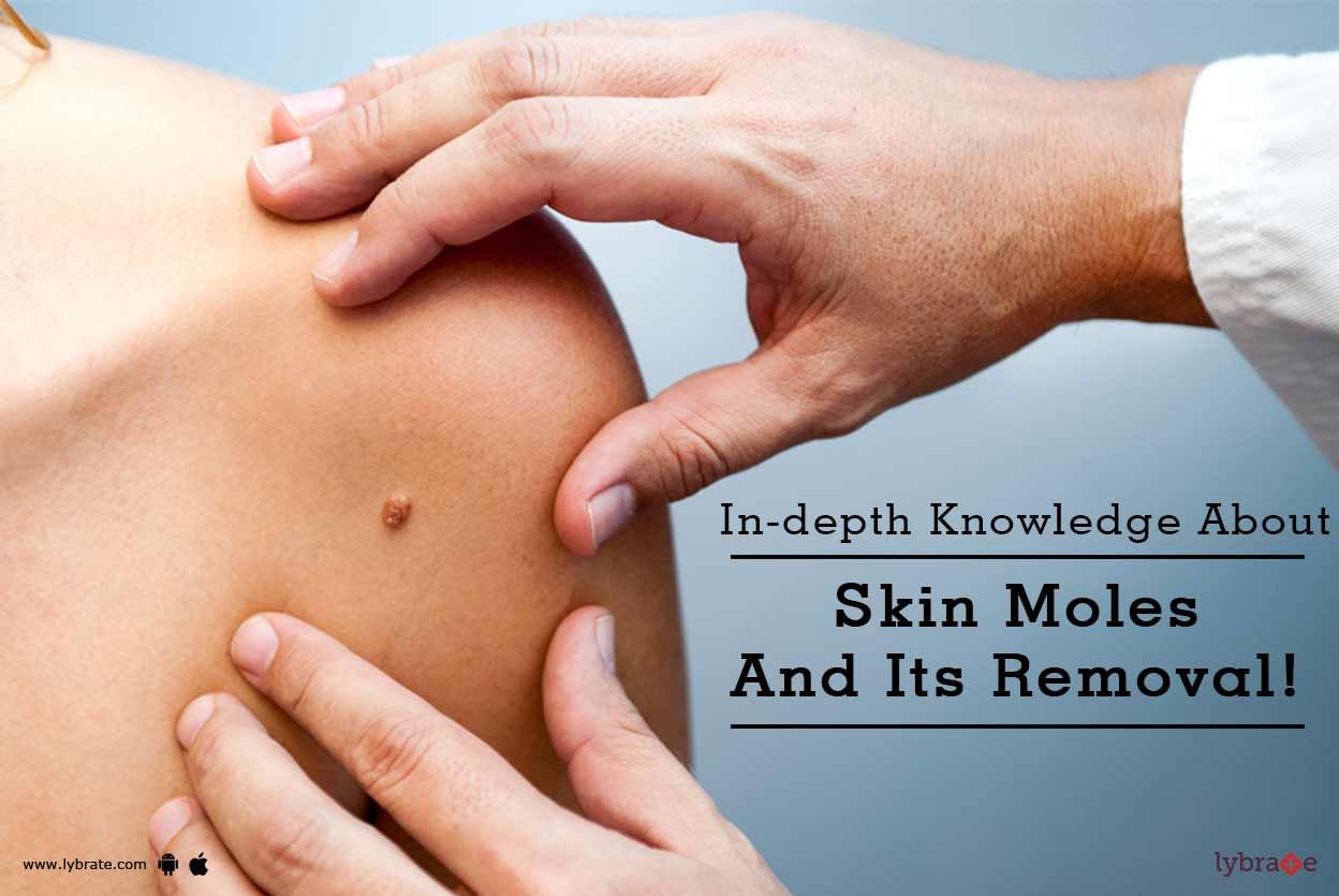 In-depth Knowledge About Skin Moles And Its Removal!