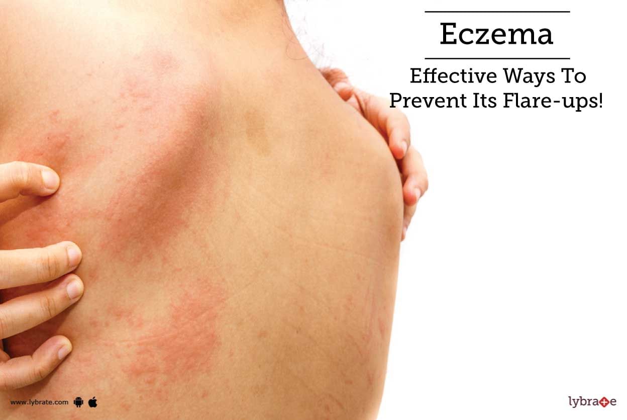 Eczema - Effective Ways To Prevent Its Flare-ups!