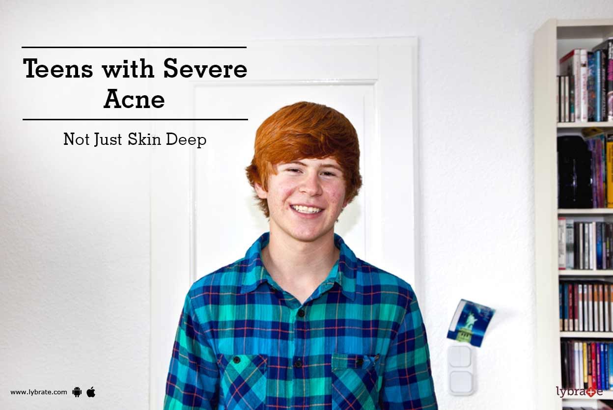 Teens with Severe Acne: Not Just Skin Deep