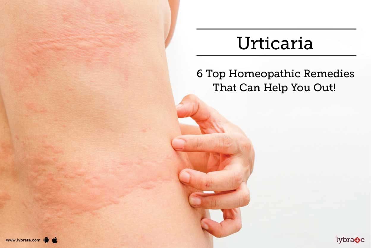 Urticaria - 6 Top Homeopathic Remedies That Can Help You Out!