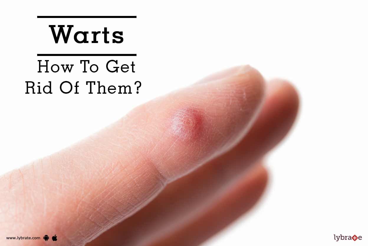 Warts - How To Get Rid Of Them?